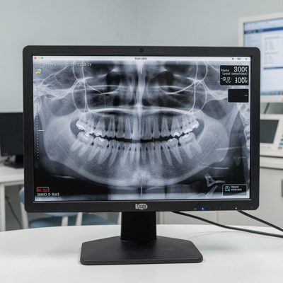 a dental x ray displayed on a monitor