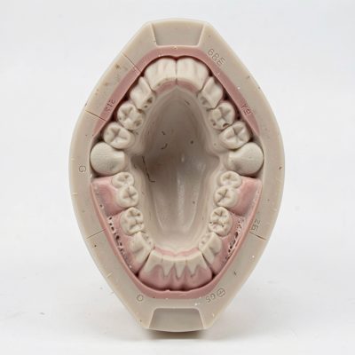 an impression tray with moulding material