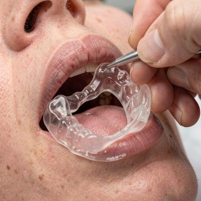 a whitening tray being fitted